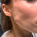 Vanlig komplikation i massetermuskeln efter Botox